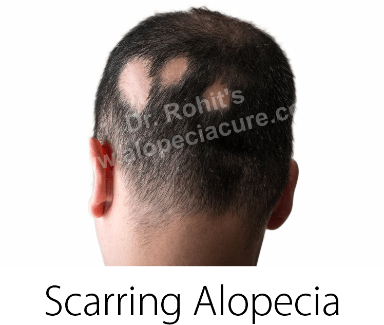 scarring alopecia